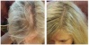i-Restore-helmet-laser-hair-growth-europe-norge-denmark-sweden-suomi-before-after-4