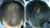 i-Restore-helmet-laser-hair-growth-europe-norge-denmark-sweden-suomi-before-after-2