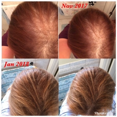 i-Restore-helmet-laser-hair-growth-europe-norge-denmark-sweden-suomi