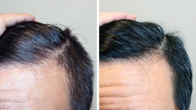 i-Restore-helmet-laser-hair-growth-europe-norge-denmark-sweden-suomi-before-after-5