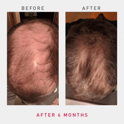 irestore-pro-uk-europe-laser-hair-growth-system-4