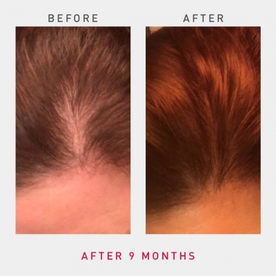 irestore-pro-uk-europe-laser-hair-growth-system-5