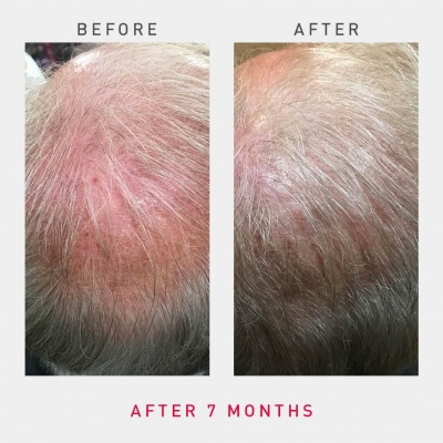 irestore-pro-uk-europe-laser-hair-growth-system-6